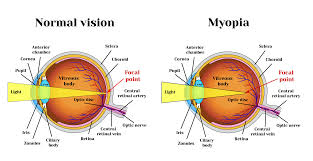 Bateseyeexercises Com Myopia Exercises