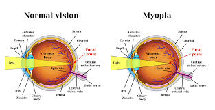 bateseyeexercises com myopia exercises