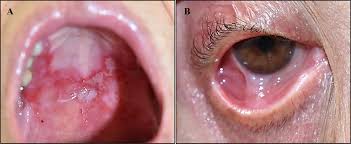 Image result for Pemphigoid