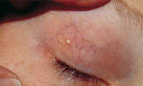 Comedones (plural of comedo) are plugged, often infected oil glands — also called blackheads and whiteheads — that are the primary signs of acne. Milia Pesky White Bumps Around The Eyes Dr Sam Bunting