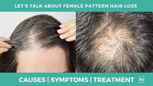 We review the evidence for each, and outline the most effective learning objective: Let S Talk About Female Pattern Baldness Female Hair Loss Treatment Ninarossatl Youtube
