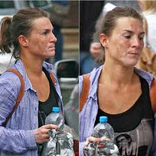 Image result for robert zaruba vitiligo