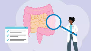 Image result for Colon Cancer Screening with Colonoscopy
