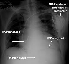 There are two major types of cardiac conduction devices: Https Www Jcpcarchives Org Pdf Is It A Pacemaker Or A Defibrillator Understanding 108 Php