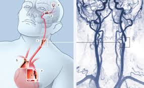 Streifung Vorbote Einer Vermeidbaren Katastrophe Hirslanden