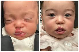 They're also known as senile angiomas or campbell de morgan spots. New York Hemangiomas Before And After Photos Los Angeles