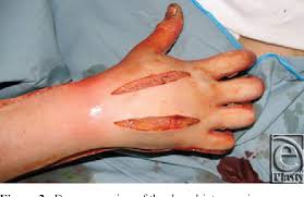 If edema forms in an injured extremity the eschar restricts the outward expansion of tissue. Pdf Amputation Following Hand Escharotomy In Patients With Burn Injury Semantic Scholar