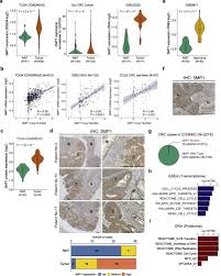 Cells from the malignant tumors can invade and damage. Novel Oncogene 5mp1 Reprograms C Myc Translation Initiation To Drive Malignant Phenotypes In Colorectal Cancer Ebiomedicine