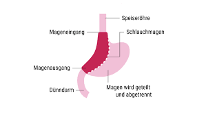 Magenverkleinerung Voraussetzungen Fur Die Op Focus Arztsuche