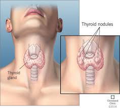 Instead, these symptoms can be caused by a thyroid nodule—and thyroid nodules aren't necessarily cancerous. Thyroid Nodule Causes Signs Symptoms Diagnosis Treatment