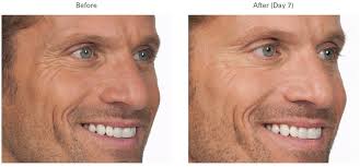 We did not find results for: Botox For Men Forehead Crow S Feet Lines Between Eyes Spa 35
