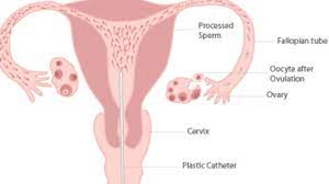 Frequently Asked Questions On Intrauterine Insemination Iui Dr Gan Kam Ling