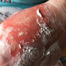 A review of adverse cutaneous events reported in sweden as associated with this drug. Steven Johnson S Syndrome Home Facebook