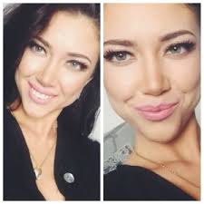 Diese stars haben sich unters. Nasenkorrektur Rhinoplastik Koln Estheticon De