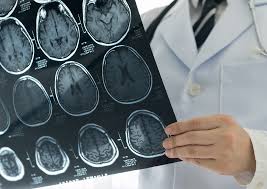 Jun 05, 2021 · a esclerose múltipla atinge 15 pessoas a cada 100 mil no brasil e costuma afetar pessoas mais jovens, sobretudo mulheresi. Fases Do Diagnostico De Esclerose Multipla Em One To One