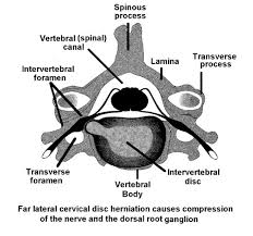 Radiculopathies