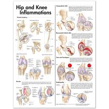 Hip And Knee Inflammations Anatomical Chart 20 X 26