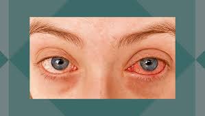 紅眼症可大可小虹膜炎的診斷和治療| HKU Ophthalmology