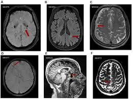 Image result for Incidental Imaging Finding