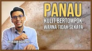 Meskipun tidak sakit dan berbahaya, panu yang muncul di beberapa area. Rawatan Penyakit Panau Apa Dan Bagaimana Panau Terjadi Cara Mengatasi Panau Di Muka Dan Badan Youtube