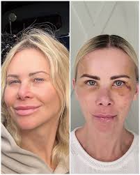 1 week post browlift, upper and lower blepharoplasty as well as facial...