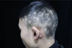 The symptoms of secondary syphilis will go away with or without treatment. Hair Loss And Lymphadenopathy The Bmj