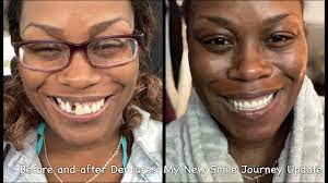 We did not find results for: Before And After Dentures My New Smile Journey Youtube