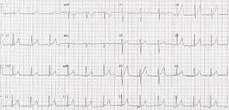 In about half of all patients with pericarditis, the heart rhythm goes through a sequence of four distinct patterns. Cureus Early Repolarization Vs Acute Pericarditis Morphology A Case Report Of Electrocardiographic Mimicry