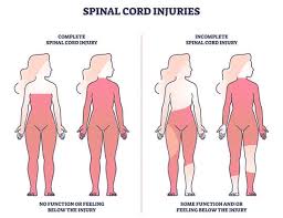 Image result for Spinal Trauma