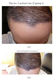 N engl j med 1999; Pilot Study Of 15 Patients Receiving A New Treatment Regimen For Androgenic Alopecia The Effects Of Atopy On Aga Abstract Europe Pmc