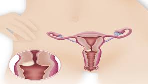 Most uterine cancers are endometrial cancers, which originate in the lining of the uterus. Pcos And Endometrial Cancer What Women Need To Know Pcos Nutrition Center