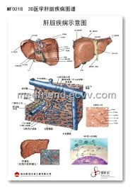 3d medical anatomical pvc chart liver disease from china