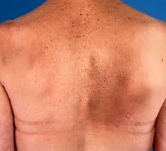 Image result for Notalgia Paresthetica