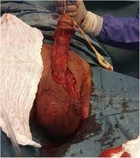 It commonly occurs in older men, but it can also occur in women and children. Isolated Penile Fournier S Gangrene A Case Report And Literature Review Sciencedirect