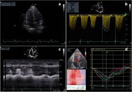 Cor Pulmonale The Role Of Traditional And Advanced Echocardiography In The Acute And Chronic Settings Springerlink