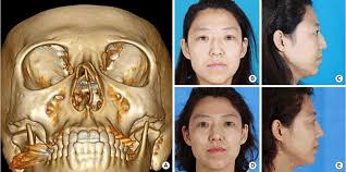The diagnosis is usually made on the. Clinical And Experimental Otorhinolaryngology