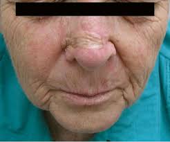 2 Woman having previously undergone wide excision of a mid-nasal BCC...