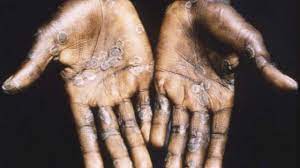 It is caused by monkeypox virus and is usually transmitted to humans through bites or via contact with an animal's blood. Sc3oiuhvuxj7um