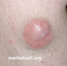 Image result for Merkel Cell Carcinoma