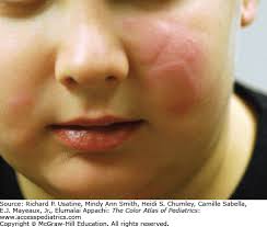 Urticaria and Angioedema