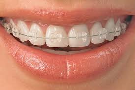 Find all the answers and more in our revealing article. How Are Ceramic Braces Put On Know If You Re Best Candidate For This