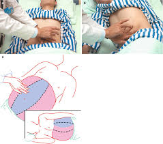 Image result for Shifting Dullness Test