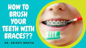 Dental braces make cleaning much more difficult because food particles can adhere to the typically, without braces, a person needs to brush two minutes. How To Brush Your Teeth With Braces On à¤¬ à¤° à¤¸ à¤¸ à¤• à¤¸ à¤¥ à¤¬ à¤°à¤¶ à¤• à¤¸ à¤•à¤° Dr Srishti Bhatia Youtube