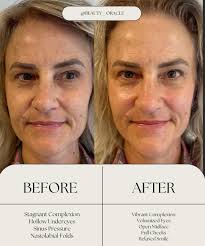 Instant results with the natural lift facial 😍 #glow #facial #tropic