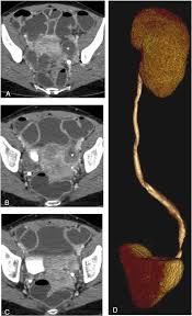 Multislice computed tomography with colon water distension (MSCT-c) in the  study of intestinal and ureteral endometriosis