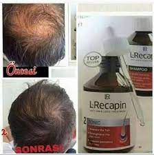 Sac Cikaran Sampuan Ve Serum Serum Sac Sampuan