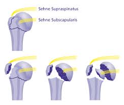 Humeruskopffraktur Bruch Des Oberarmkopfes Gelenk Klinik De