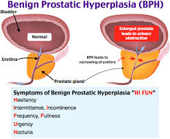 Benign Prostatic Hyperplasia Bph Benign Prostatic Hyperplasia Nurse Training Neonatal Nurse