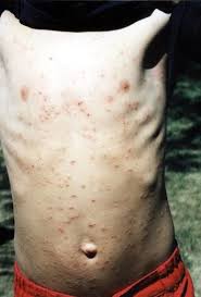 Image result for Trombicula autumnalis bites