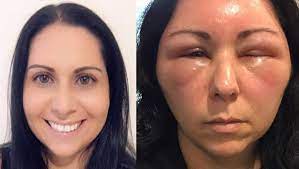 Fitness blogger shares horrifying photos of her swollen face after she had a 'nightmare' allergic reaction to henna hair dye which left her unable to see and in severe pain. Woman S Allergic Reaction To Hair Dye Causes Severe Swelling In Face Head